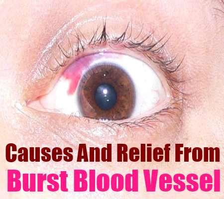 Causes And Relief From Burst Blood Vessel – Natural Home Remedies ...