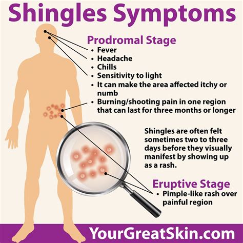 Shingles Symptoms No Rash Treatment - Infoupdate.org