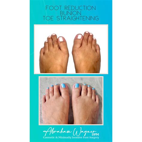 Cinderella Surgery: What to Know About the Trending Foot Procedure