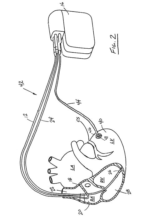 Patent US7270669 - Epicardial lead placement for bi-ventricular pacing using thoracoscopic ...