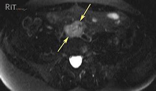 RiT radiology: Extraadrenal Pheochromocytoma: MRI