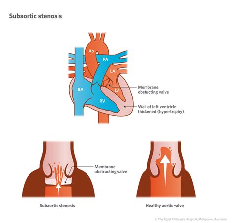 Classification Of Aortic Stenosis