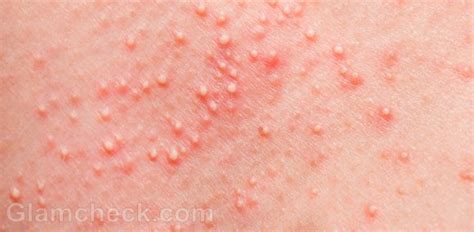 Heat Rash : Causes, Symptoms & Treatment