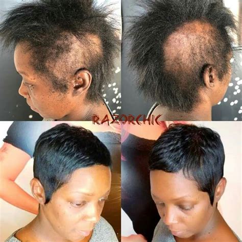 29+ short hairstyles for alopecia - AnnesKiaran