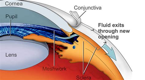 Incisional Glaucoma Surgery - Glaucoma Associates of Texas