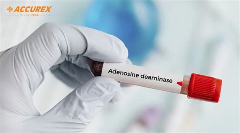 Adenosine Deaminase | ADA Test & Synthesis | Tuberculosis