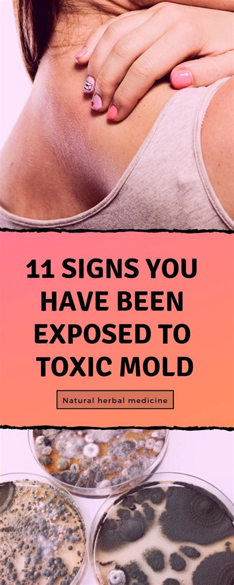 11 Signs You Have Been Exposed To Toxic Mold | Toxic mold, Toxic mold symptoms, Mold exposure