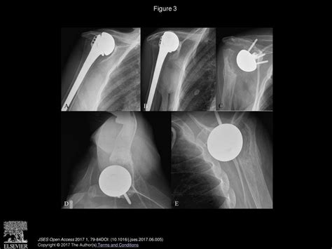 Reverse hemiarthroplasty - ppt download