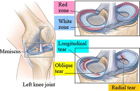 Torn Meniscus - Signs & Symptoms, Test, Diagnosis, Recovery, Treatment