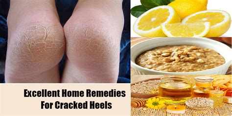 Home Remedies for Cracked Heels - Cure Cracked Feet Fast - Style Hunt World