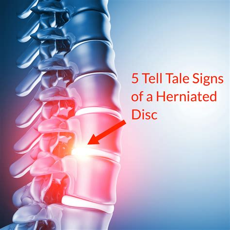 Herniated Disc Symptoms