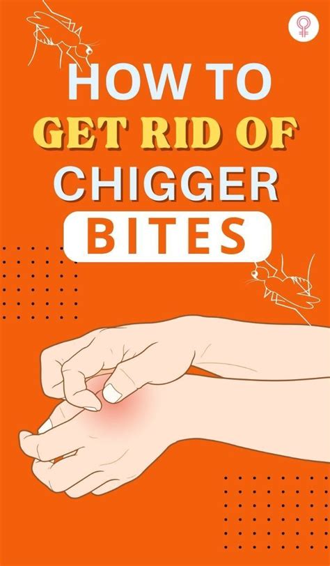 Home remedies for chigger bites prevention tips – Artofit