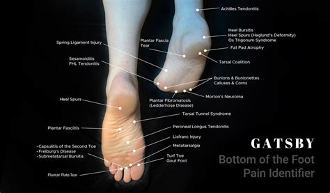 21+ Top Foot Pain Diagnosis Chart - LaurenceMahak