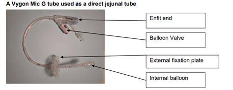 Direct (Surgically placed) Jejunostomy tube – information for parents/carers | CUH