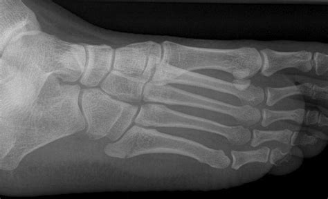 Jones Fracture • LITFL • Medical Eponym Library