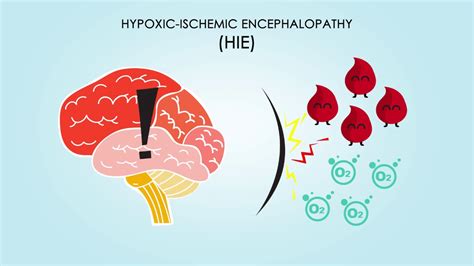 Perinatal Hypoxic Ischemic Encephalopathy