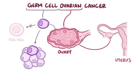 Germ cell ovarian tumor: Video, Anatomy & Definition | Osmosis