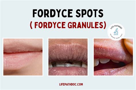 What Causes Fordyce Spots On Lips - Infoupdate.org