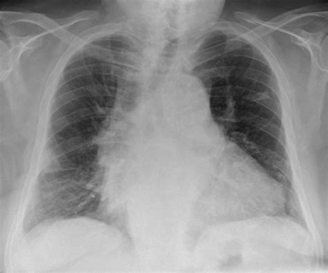 Chest X Ray Pulmonary Embolism