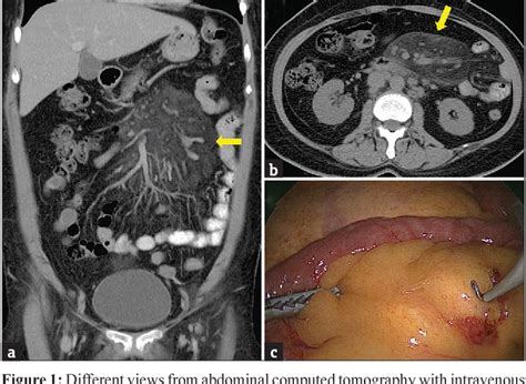 Figure 1 from Sclerosing mesenteritis | Semantic Scholar