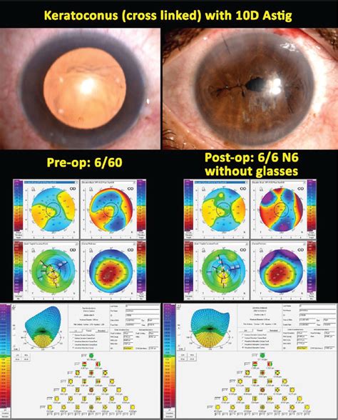 A Technique for Irregular Corneal Astigmatism