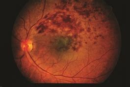 Branch Retinal Vein Occlusions – Retina Orange County