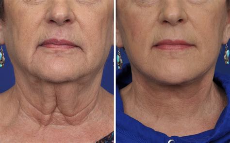 Facelift Before & After Photos Annapolis | Non Surgical Facelift