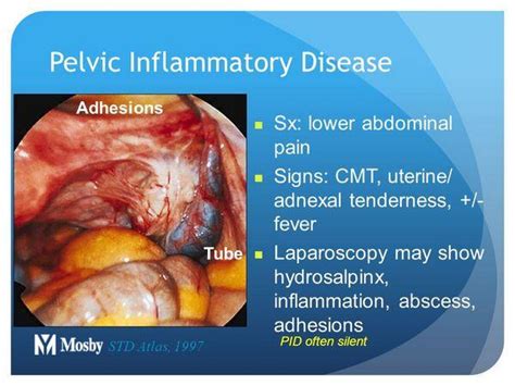 Pelvic inflammatory disease (PID) - Infections - AntiinfectiveMeds.com