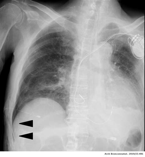 Deep Sulcus Sign in Pneumothorax | Archivos de Bronconeumología