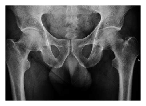 (a) X-ray of a patient with transient osteoporosis of the left hip... | Download Scientific Diagram