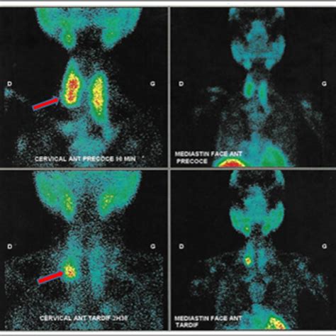 -MIBI scan showing a projecting focus at the base of the right thyroid... | Download Scientific ...