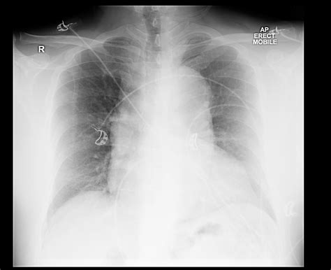 Aortic dissection x ray - wikidoc