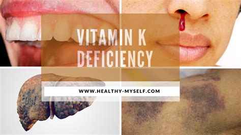 Vitamin k deficiency:Causes,Symptoms,Sources &Natural Remedies-2021