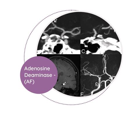 Adenosine Deaminase - (AF) - MediScan Lab