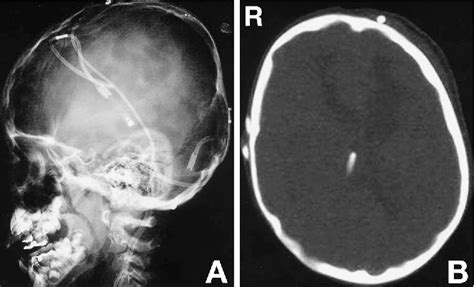 Figure 2 from Acquired lacunar skull deformity following ...