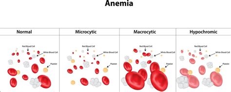 Anemia and its type - Overall Science