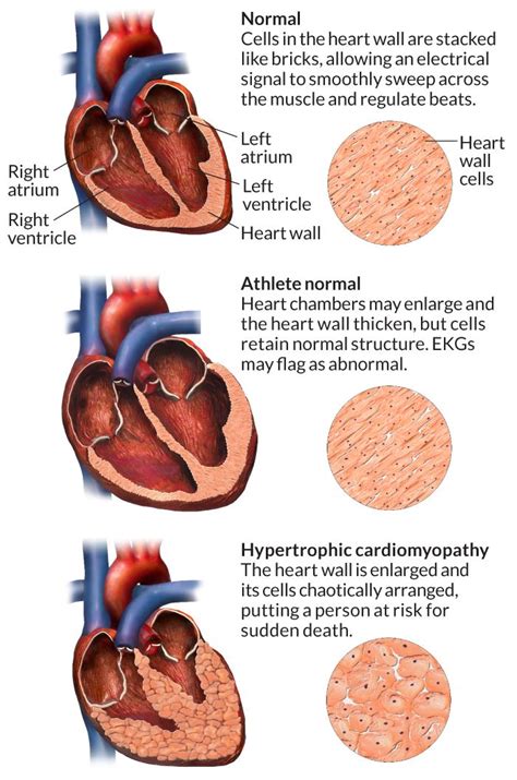 7 best HCM images on Pinterest | Hypertrophic cardiomyopathy, Med ...