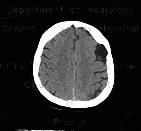 Radiology case: Arachnoid cyst, frontal lobe