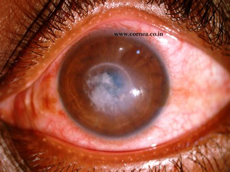 Corneal Ulcer – Cornea