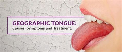 Geographic Tongue: Causes, Symptoms and Treatments | Geographic tongue ...