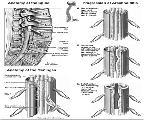 A Comprehensive Review of Spinal Arachnoiditis : Orthopaedic Nursing