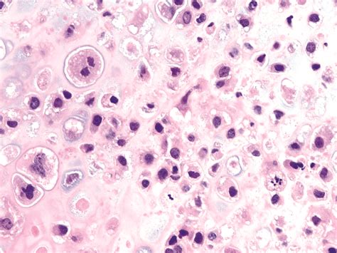 Pathology Outlines - Chondrosarcoma (primary, secondary, periosteal)