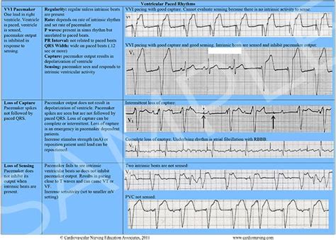 Cardiac Arrhythmias Reference Chart (Printed) – Cardiovascular Nursing Education Associates