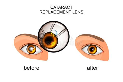 Replacement of the Crystalline Lens in Cataract Stock Vector ...