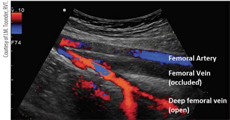 Endovascular Today - Imaging the Deep Venous System (July 2016)