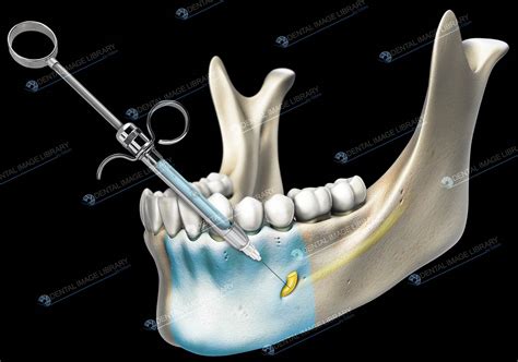 Dental Anesthesia: mental nerve block. 82JB00001 | Dental Image Library