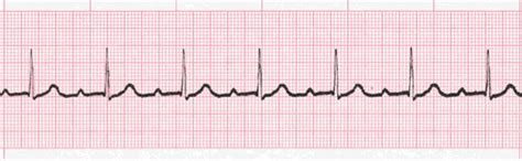 First Degree Heart Block - EKG Lesson #316