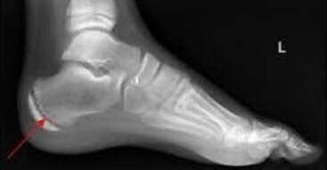 Sever's Disease / Calcaneal apophysitis - heel pain - Greg Robinson ...