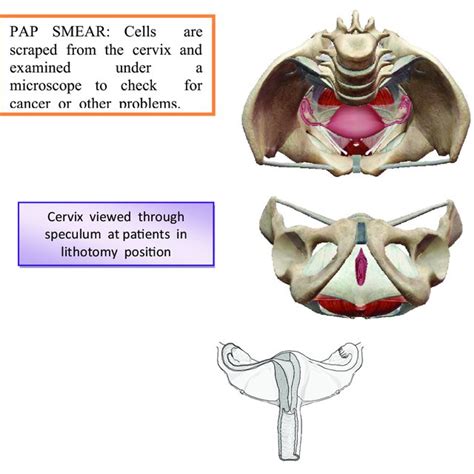 | Cone biopsy (conization of the cervix). | Download Scientific Diagram