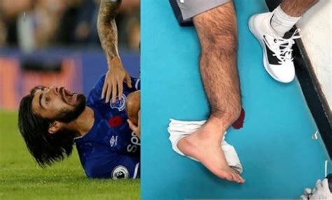 Everton's Gomes Suffers Horrific Injury Against Tottenham (Images) - Complete Sports